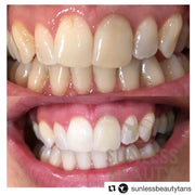 LED & Infrared Teeth Whitening in Torrance, CA at Sunless Beauty – vegan, dentist-strength CP gel with infrared red & LED blue light technology for a gentle, enamel-safe, sensitivity-free whitening experience. 50% off for Annual Pass Holders.